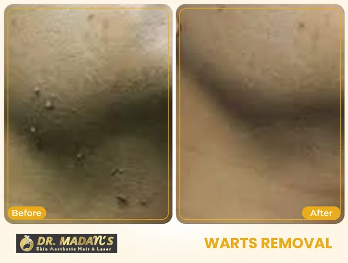 Warts removal before and after result 1 at Dr Madan Aesthetics